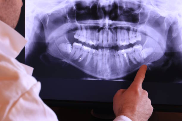 Best Emergency Wisdom Teeth Removal in Celina, TN