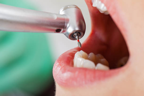 Best Emergency Dental Care for Broken or Chipped Teeth in Celina, TN